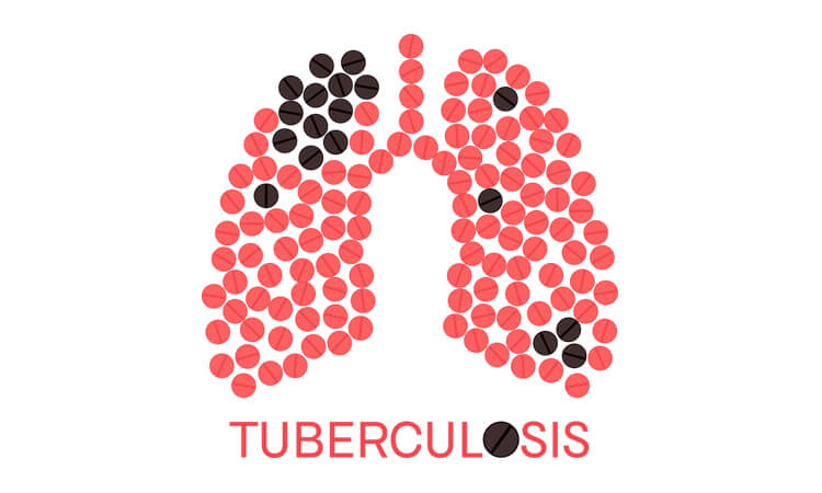 All you need to Know about Tuberculosis