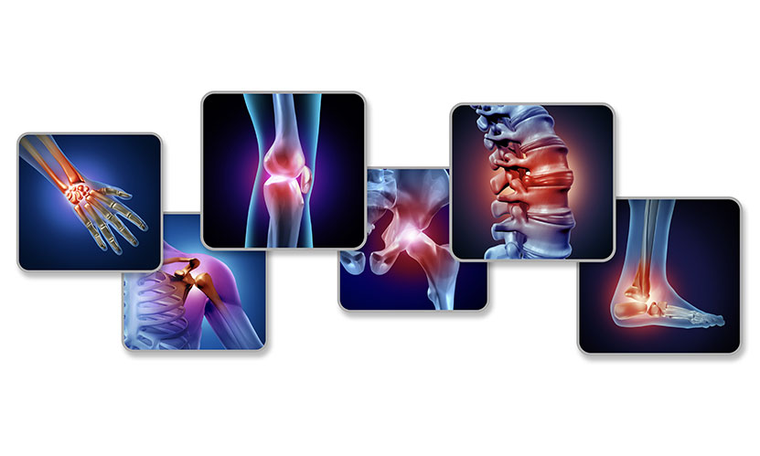 Living with Arthritis